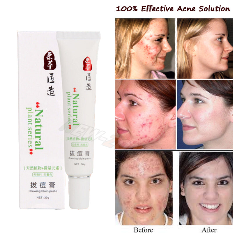 100% Effective Acne Cream Women Men Pimples Fast Heal Acne Scars Repair Red Spots Facial Smooth Care Natural Plant